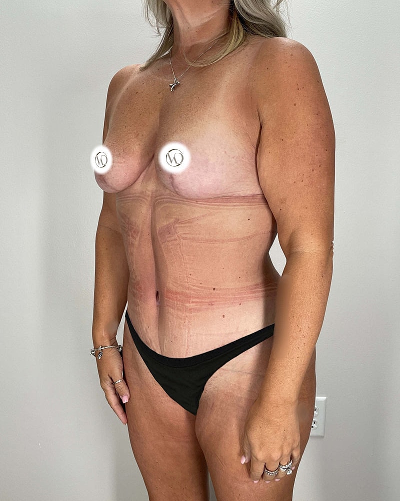 Mommy Makeover Before & After