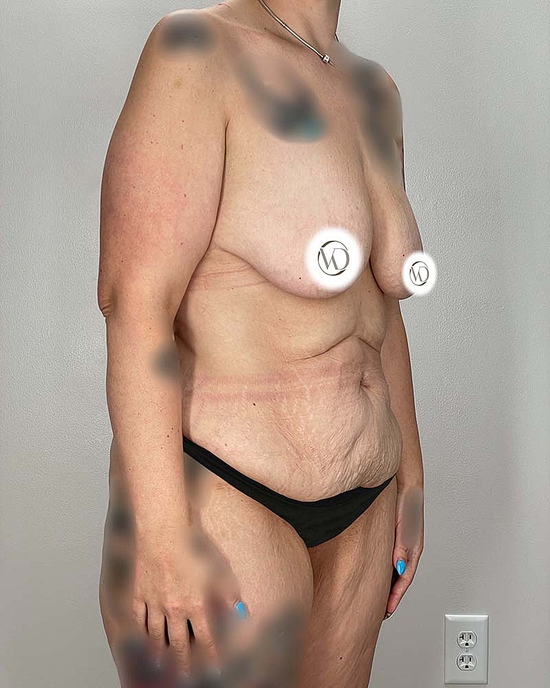 Mommy Makeover Before & After