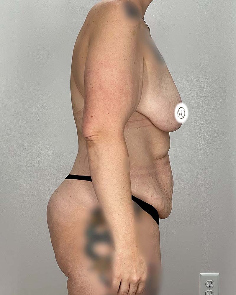 Mommy Makeover Before & After