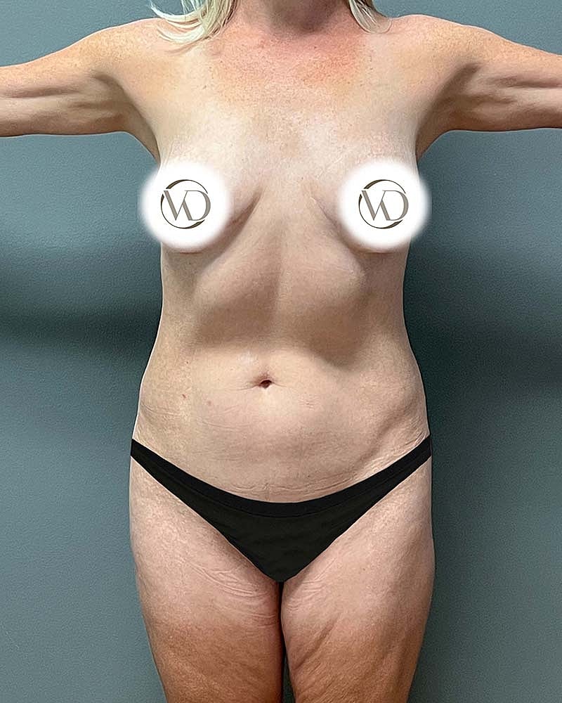 Mini Tummy Tuck Before & After