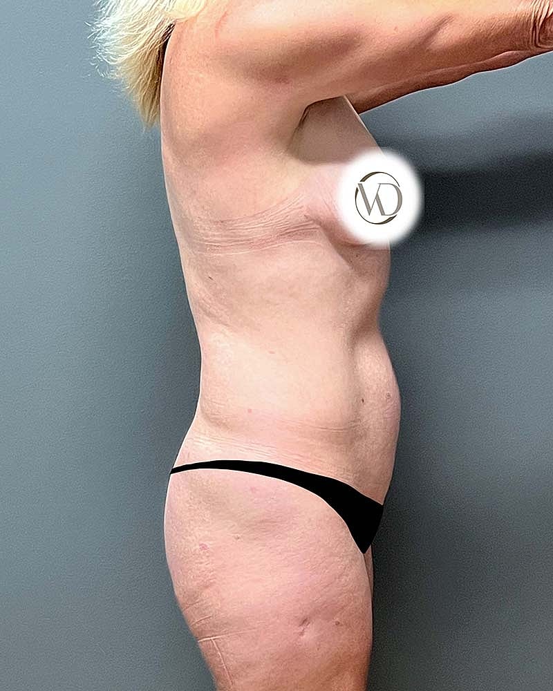 Mini Tummy Tuck Before & After