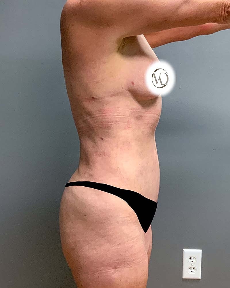 Mini Tummy Tuck Before & After