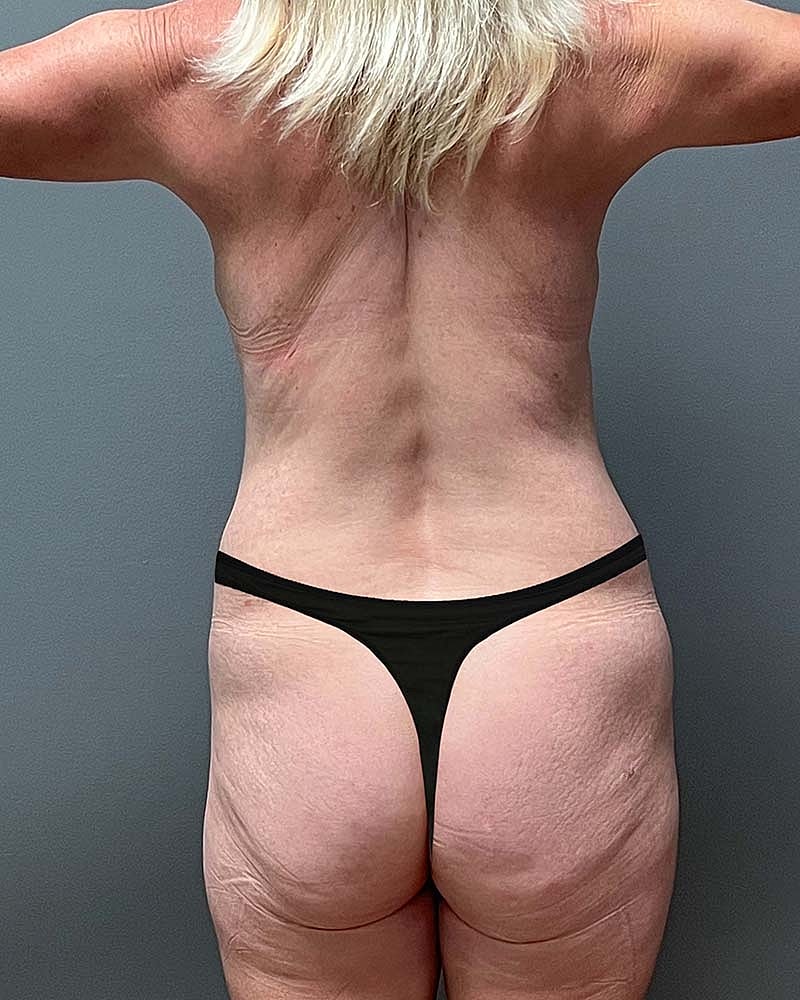 Mini Tummy Tuck Before & After