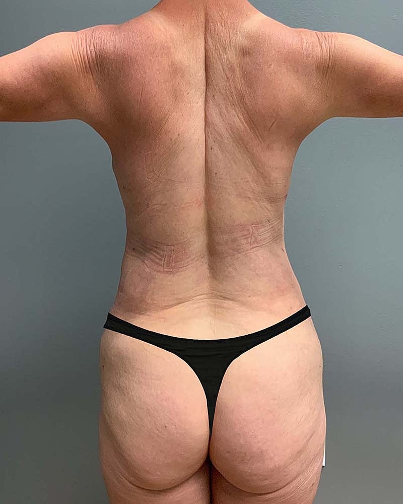 Mini Tummy Tuck Before & After