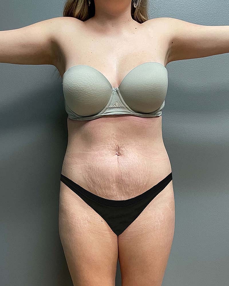 Mini Tummy Tuck Before & After
