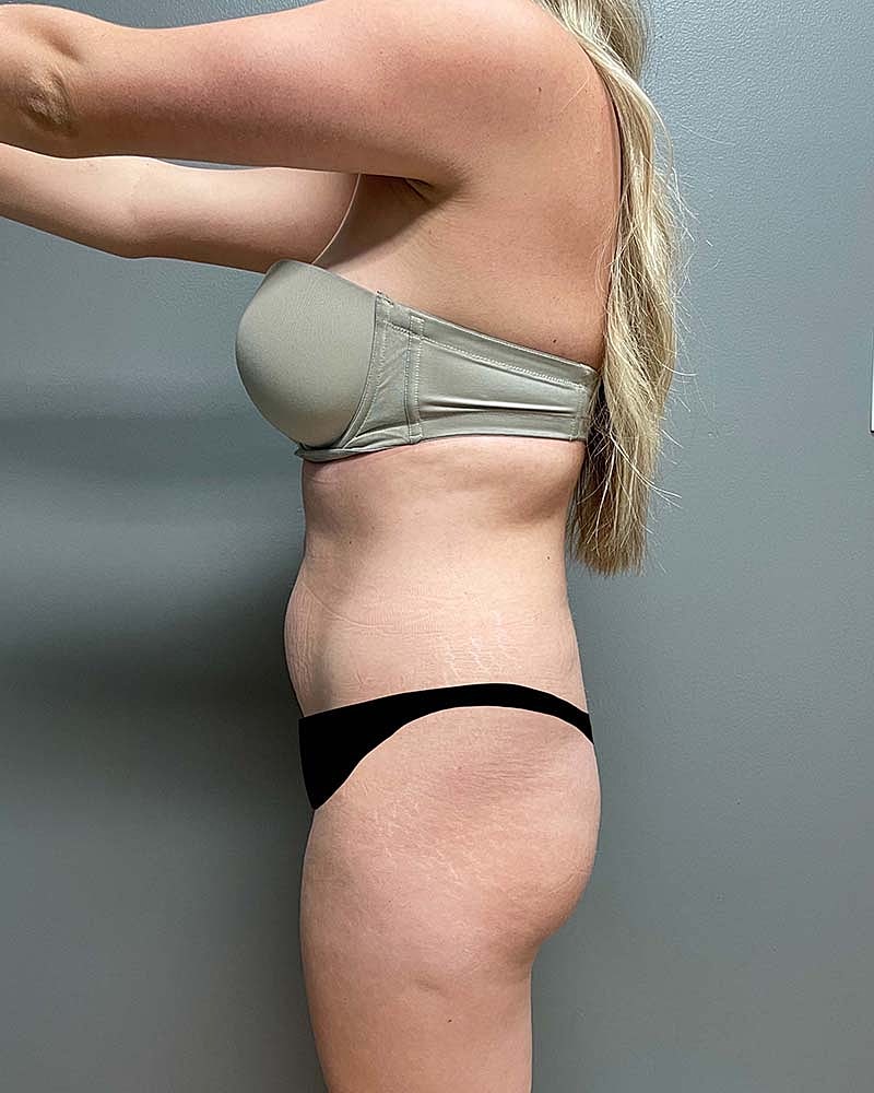 Mini Tummy Tuck Before & After