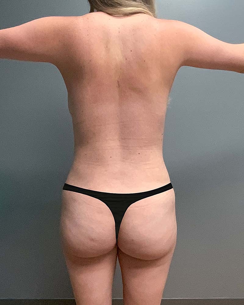 Mini Tummy Tuck Before & After