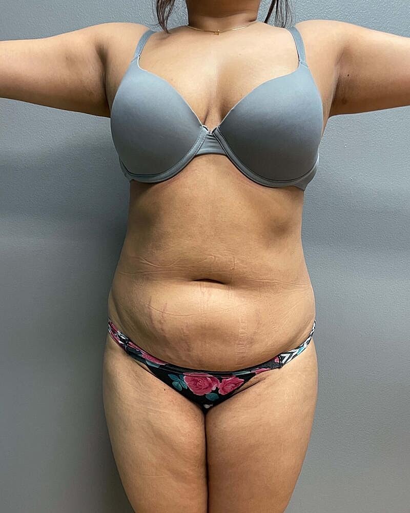 Mini Tummy Tuck Before & After