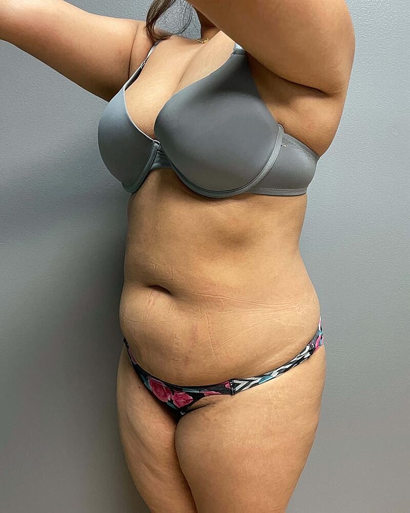 Mini Tummy Tuck Before & After