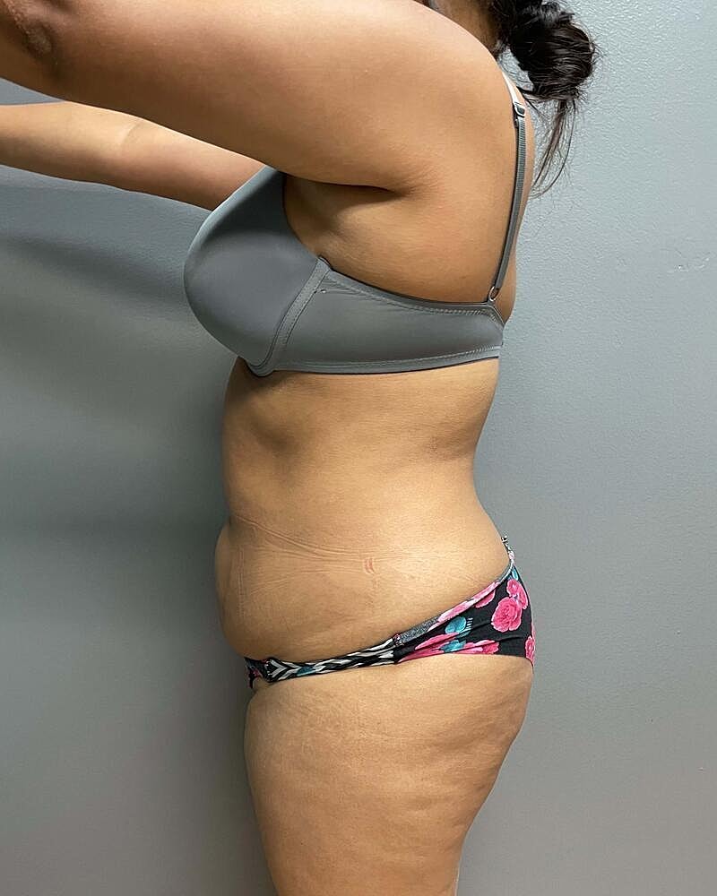 Mini Tummy Tuck Before & After