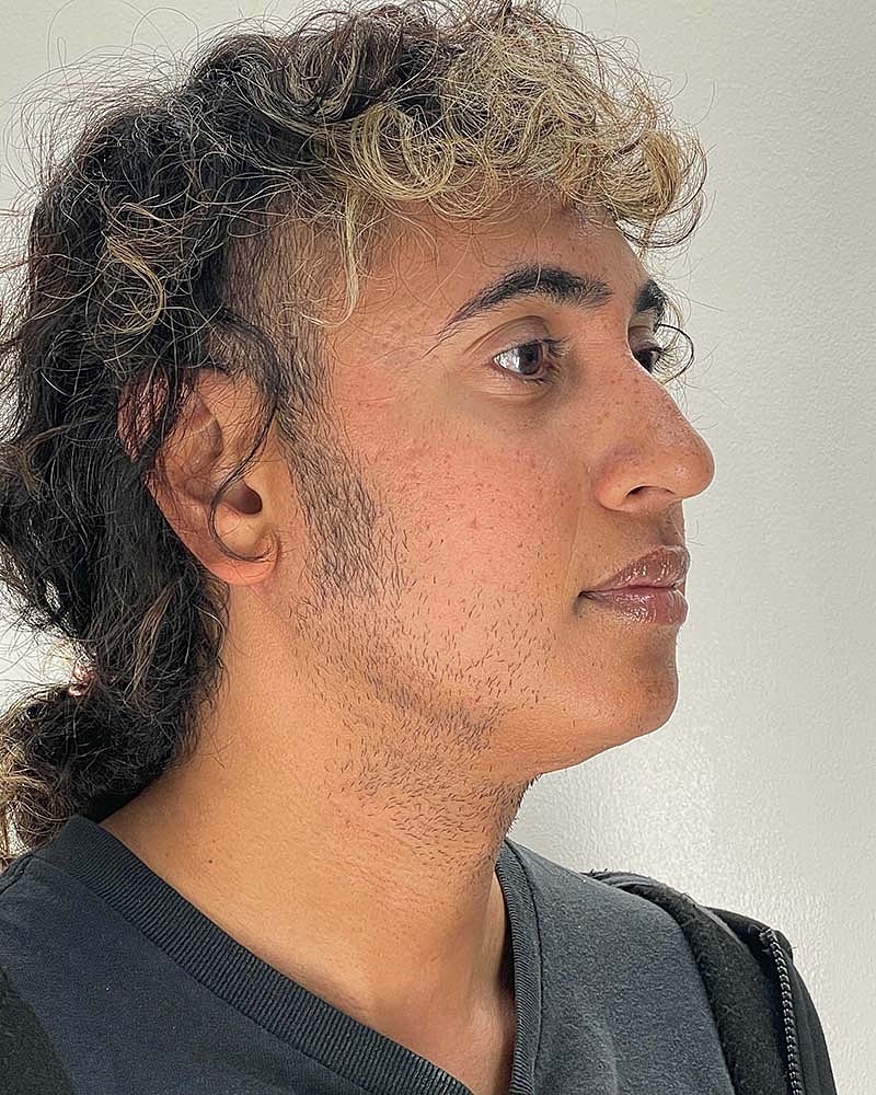 Renuvion Before & After