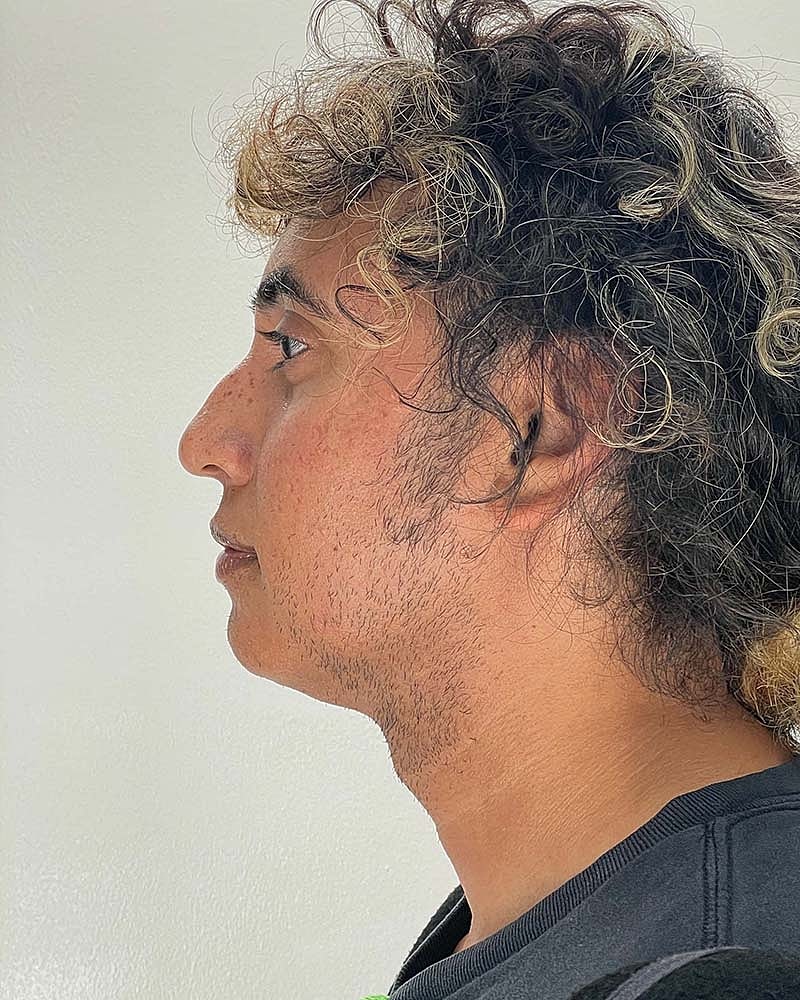 Renuvion Before & After
