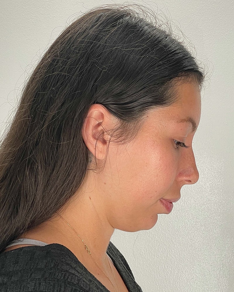 Renuvion Before & After