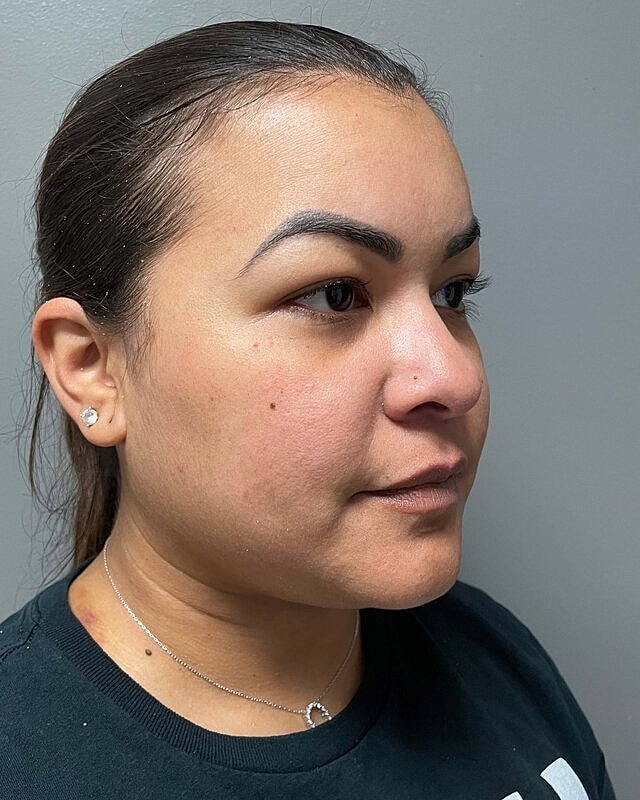 Renuvion Before & After
