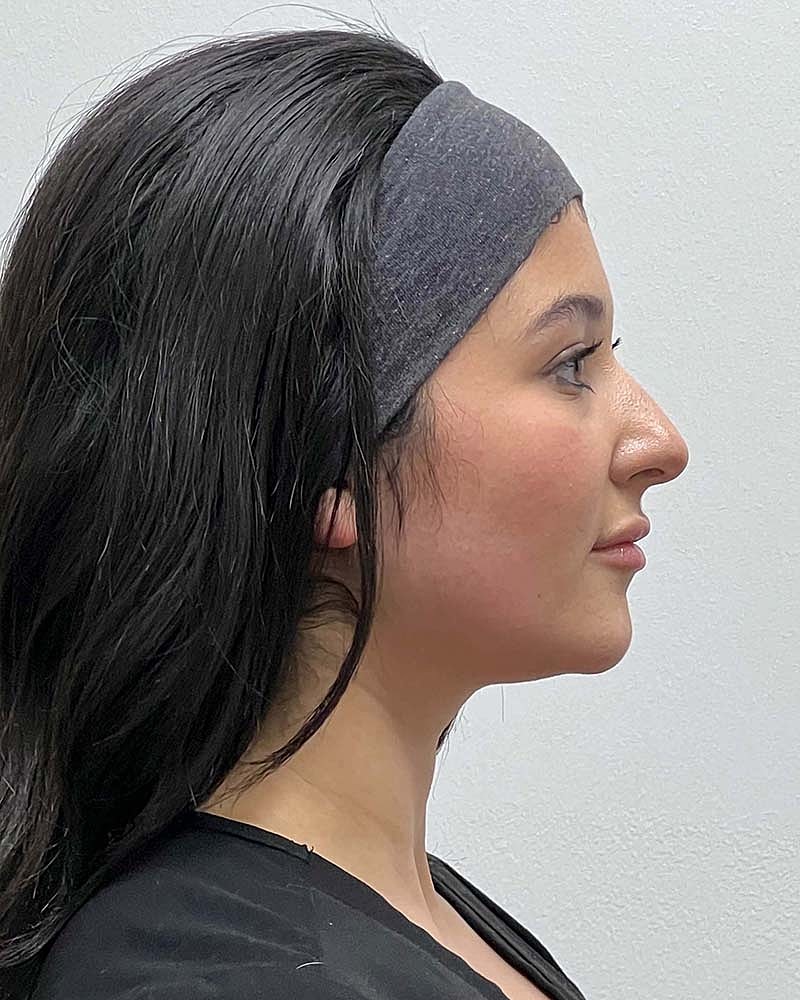 Renuvion Before & After