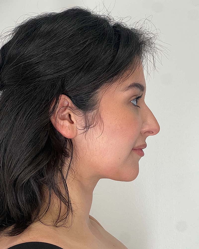 Renuvion Before & After