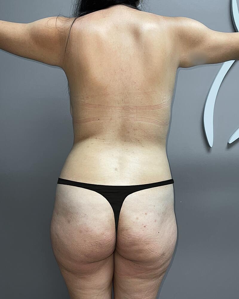 Fat Transfer Before & After