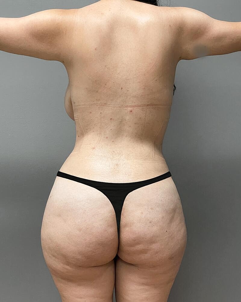Fat Transfer Before & After