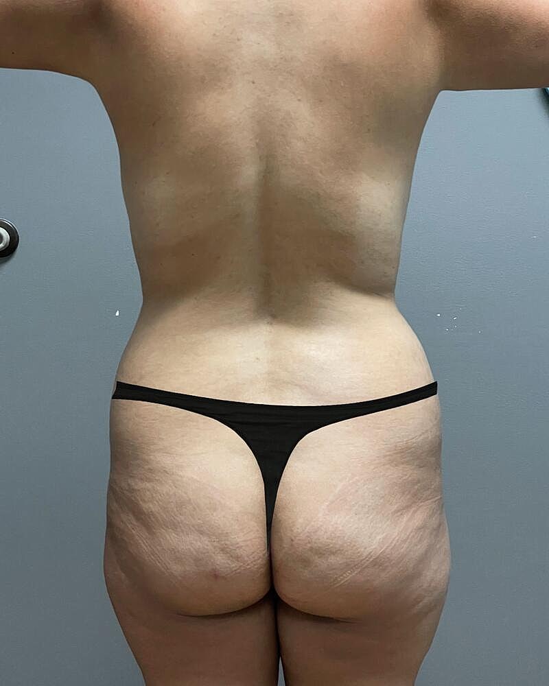 Fat Transfer Before & After