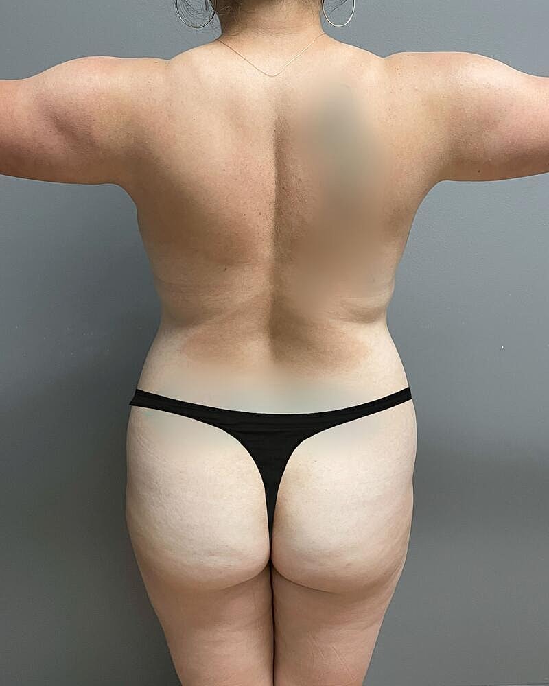 Fat Transfer Before & After