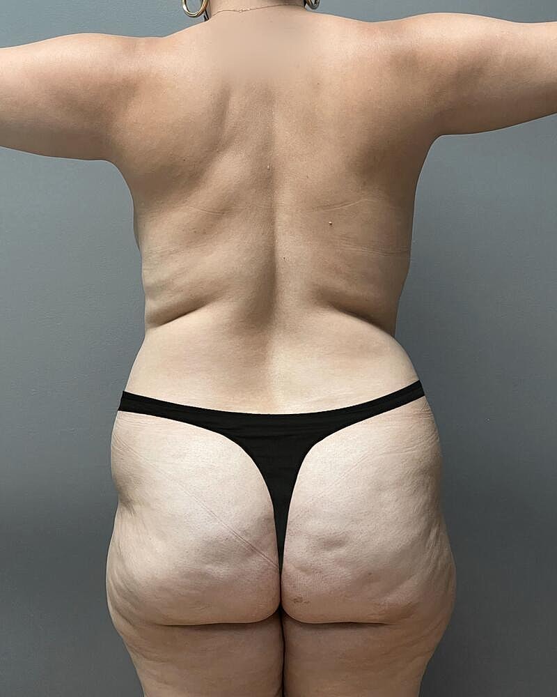 Fat Transfer Before & After