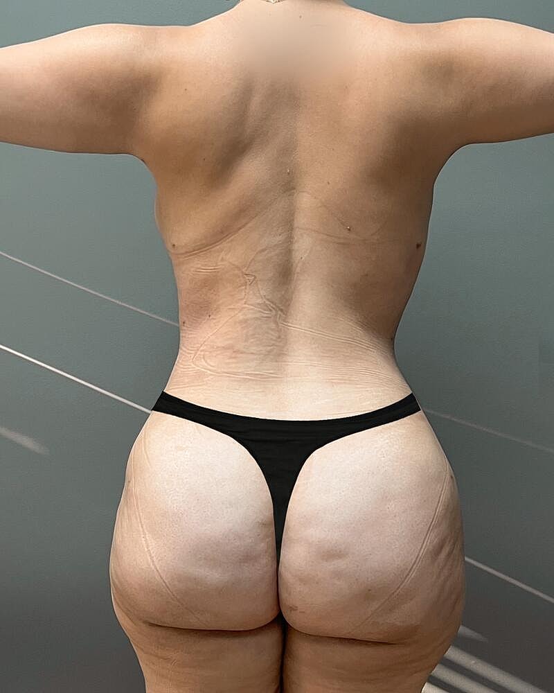 Fat Transfer Before & After