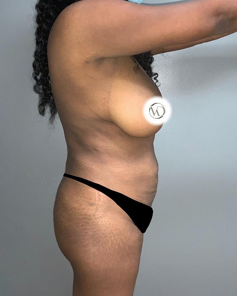 Fat Transfer Before & After