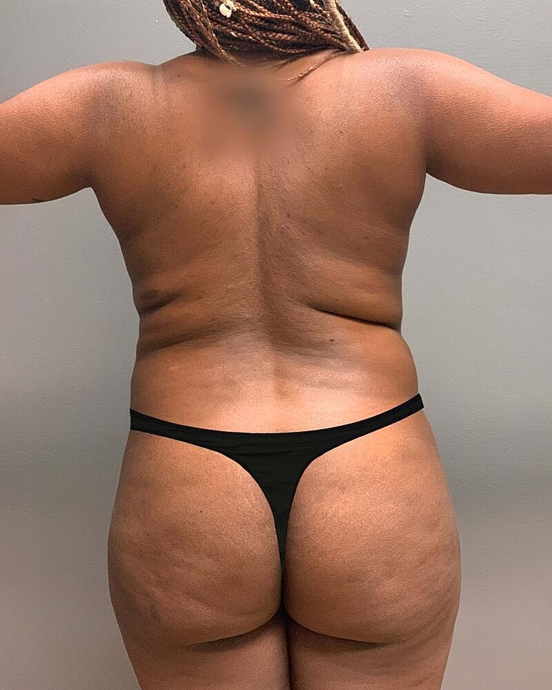 Fat Transfer Before & After
