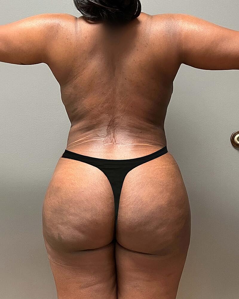 Fat Transfer Before & After