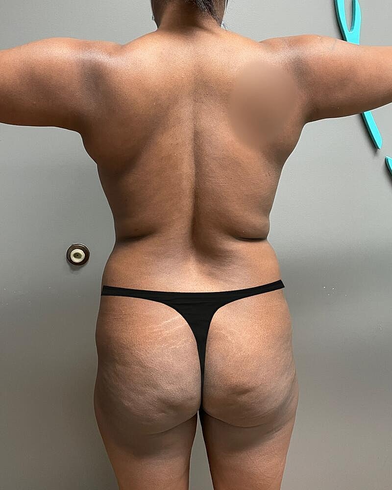 Fat Transfer Before & After