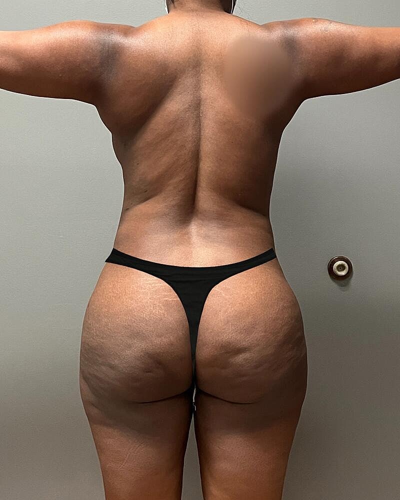 Fat Transfer Before & After