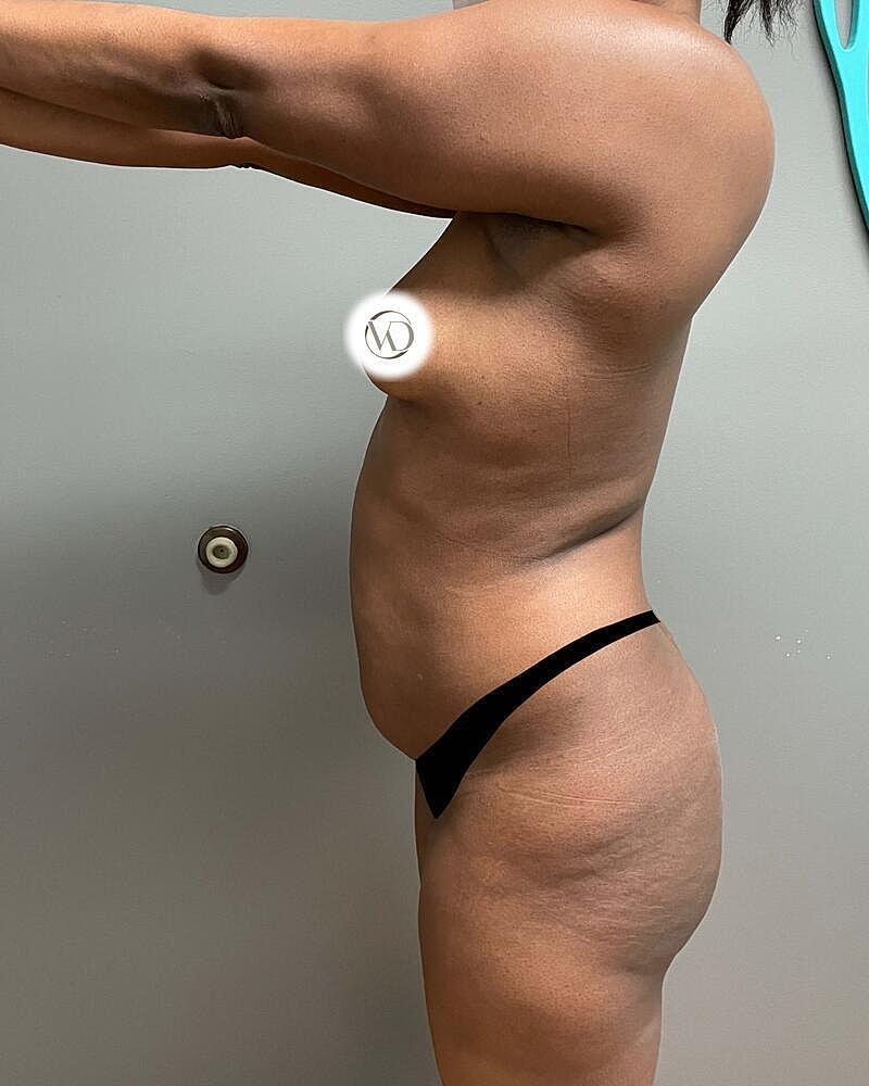 Fat Transfer Before & After
