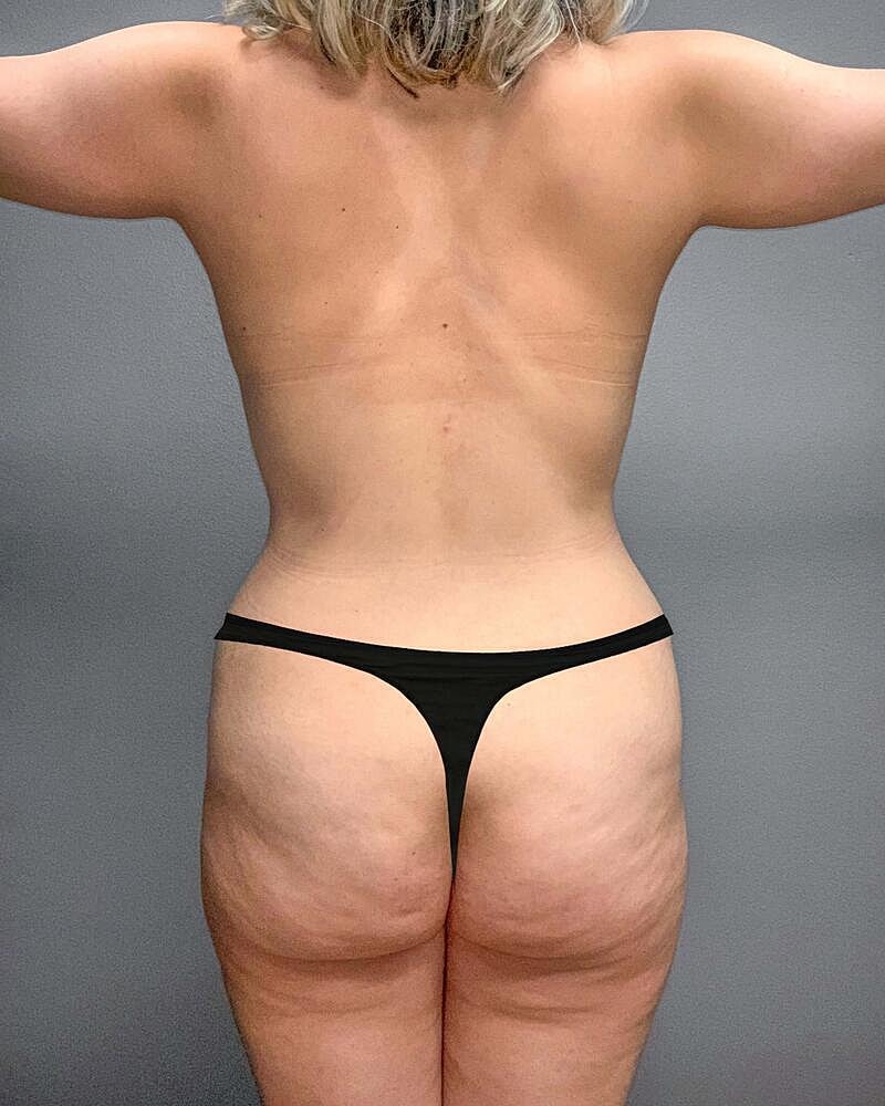 Fat Transfer Before & After