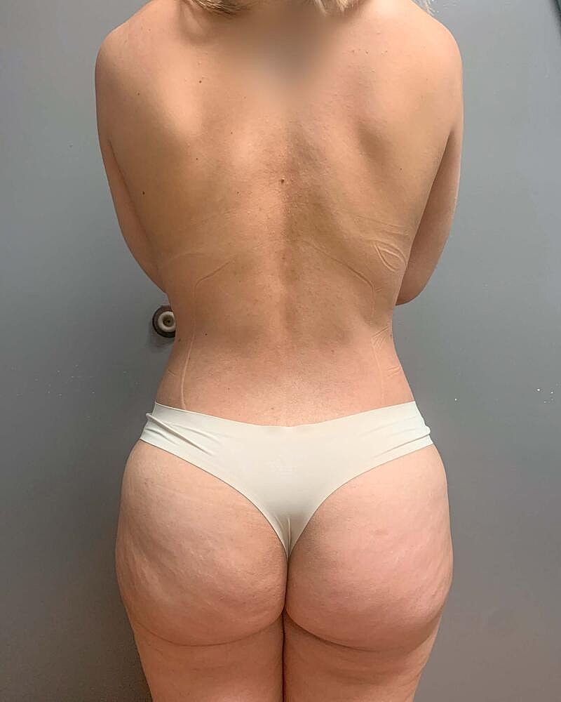 Fat Transfer Before & After