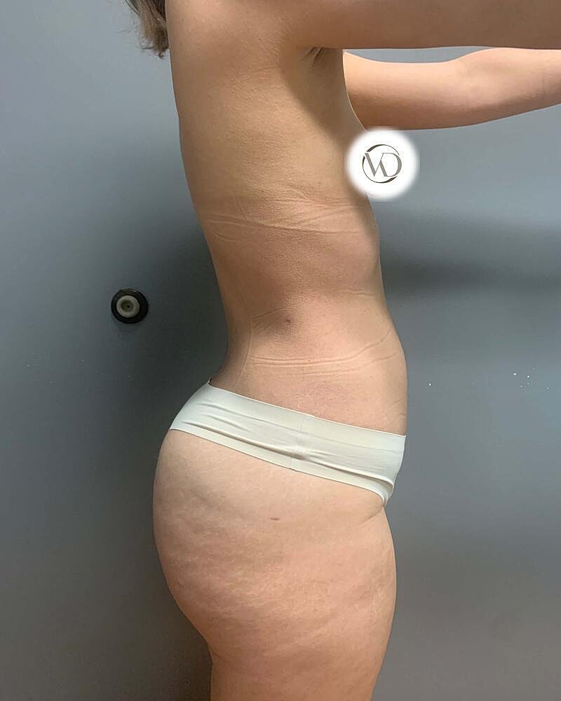 Fat Transfer Before & After