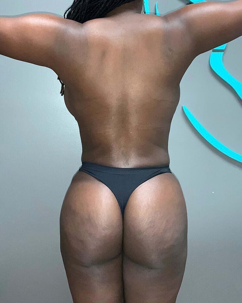 Fat Transfer Before & After