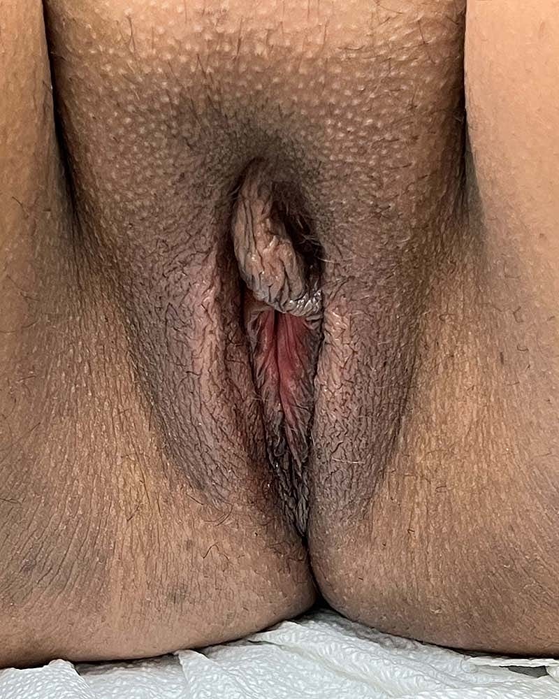 Labiaplasty Before & After