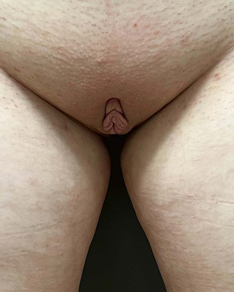 Labiaplasty Before & After