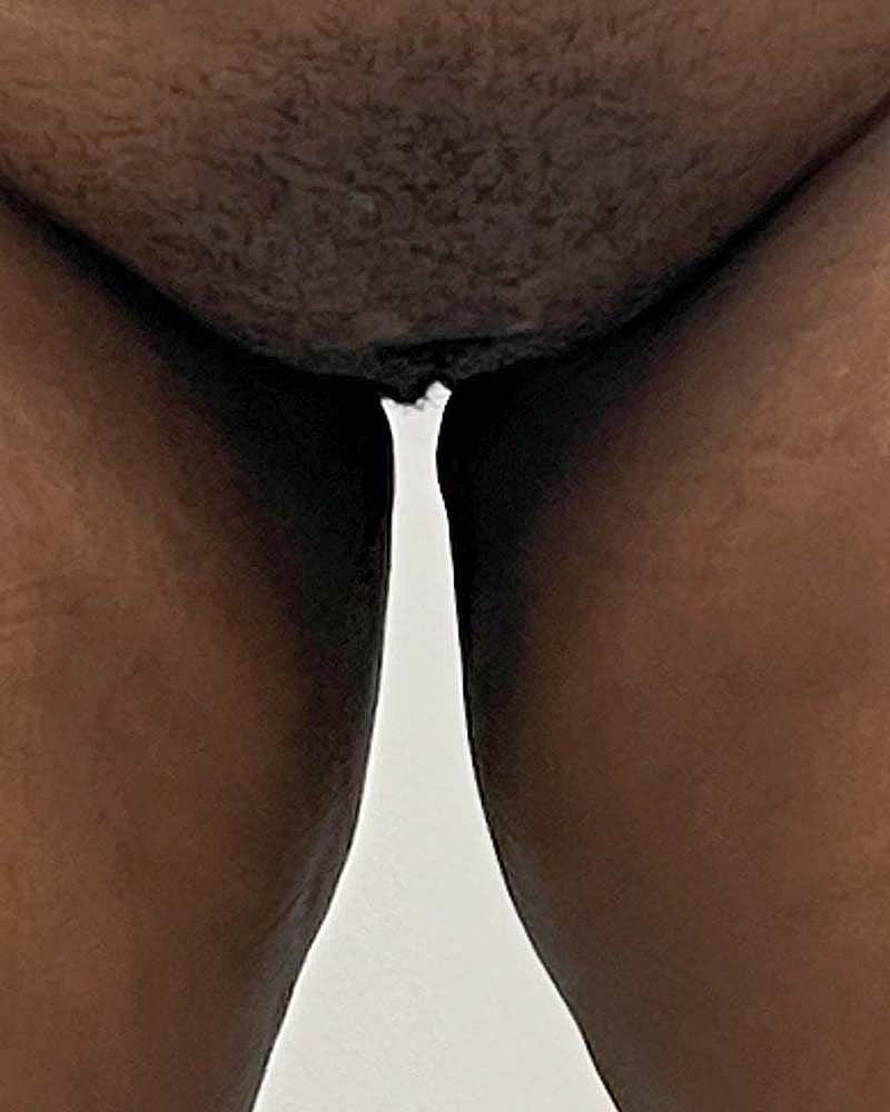 Labiaplasty Before & After