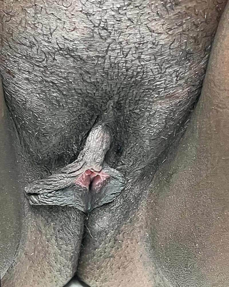 Labiaplasty Before & After