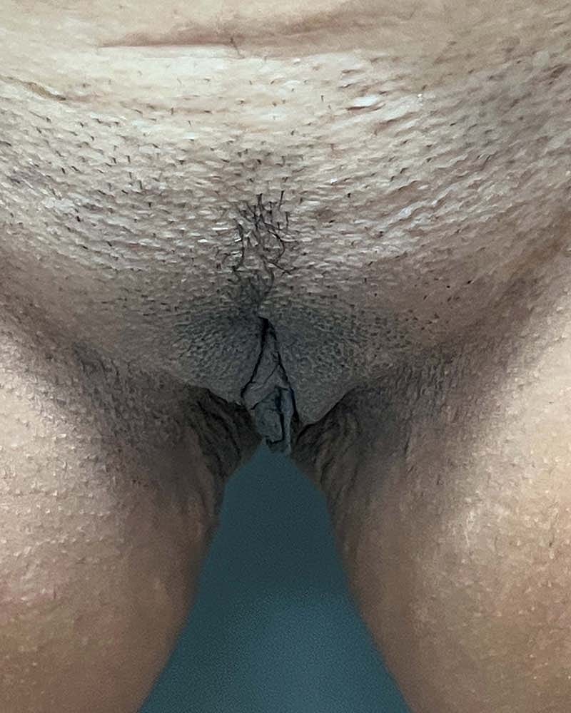 Labiaplasty Before & After