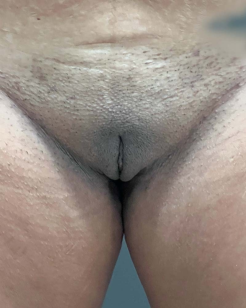 Labiaplasty Before & After