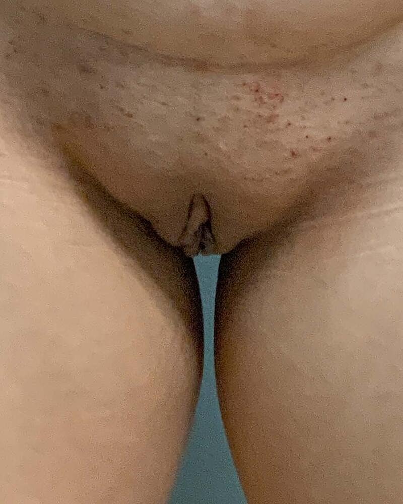 Labiaplasty Before & After