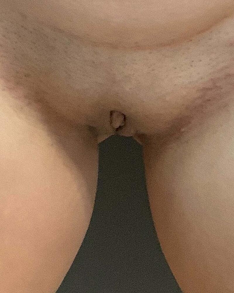 Labiaplasty Before & After