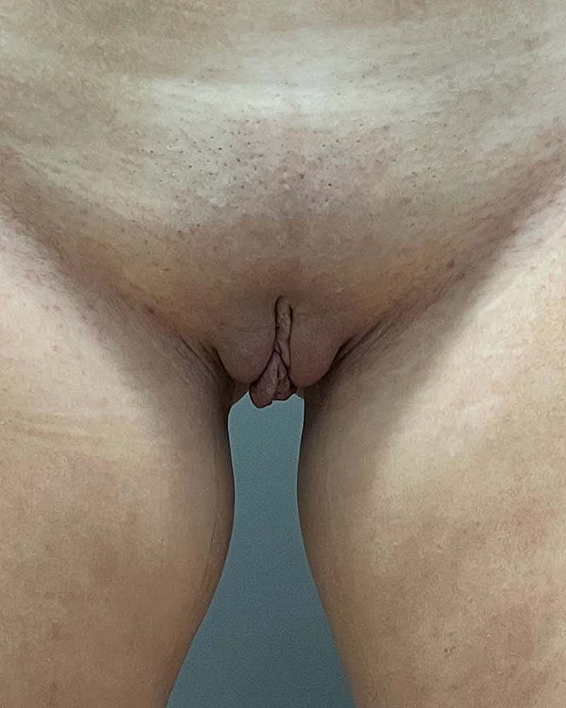 Labiaplasty Before & After