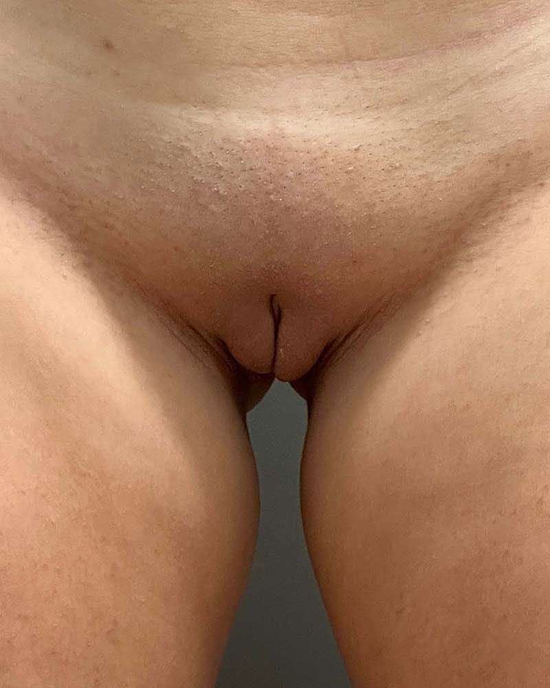 Labiaplasty Before & After