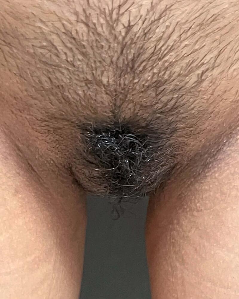 Labiaplasty Before & After
