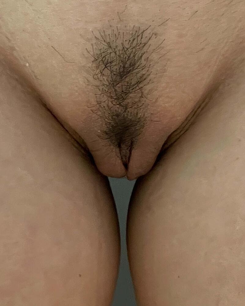 Labiaplasty Before & After