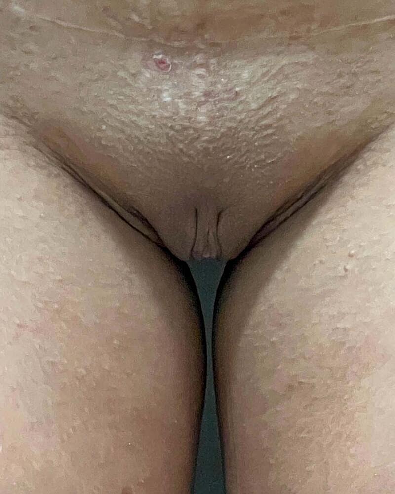 Labiaplasty Before & After