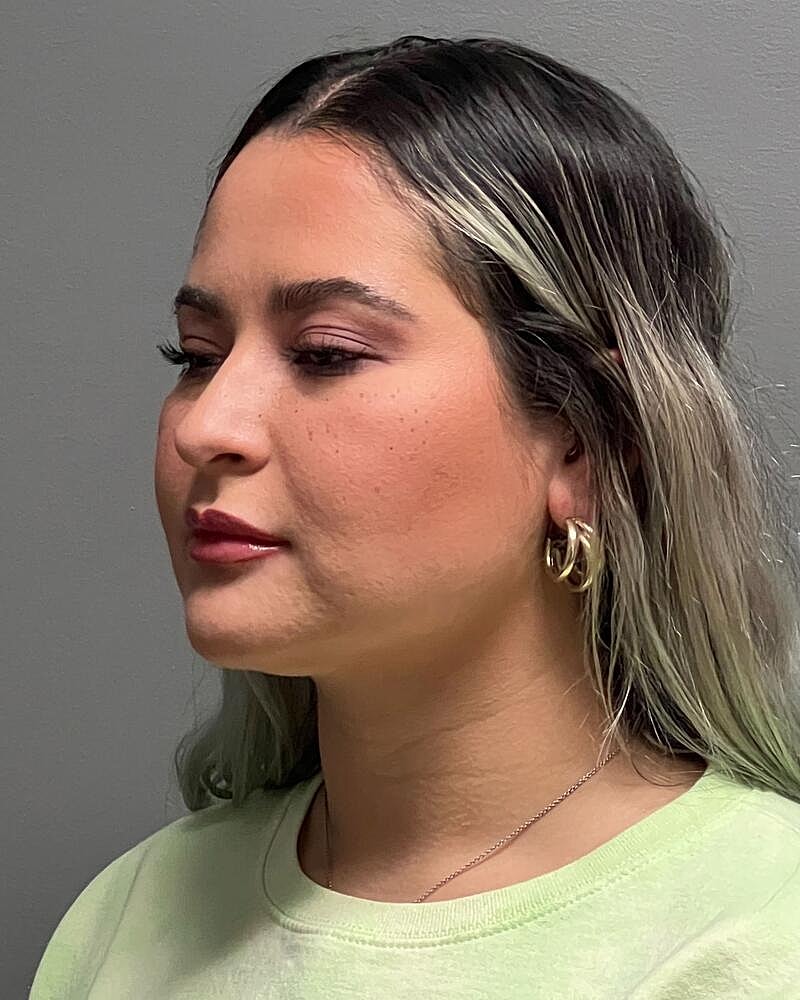 Buccal Fat Removal Before & After